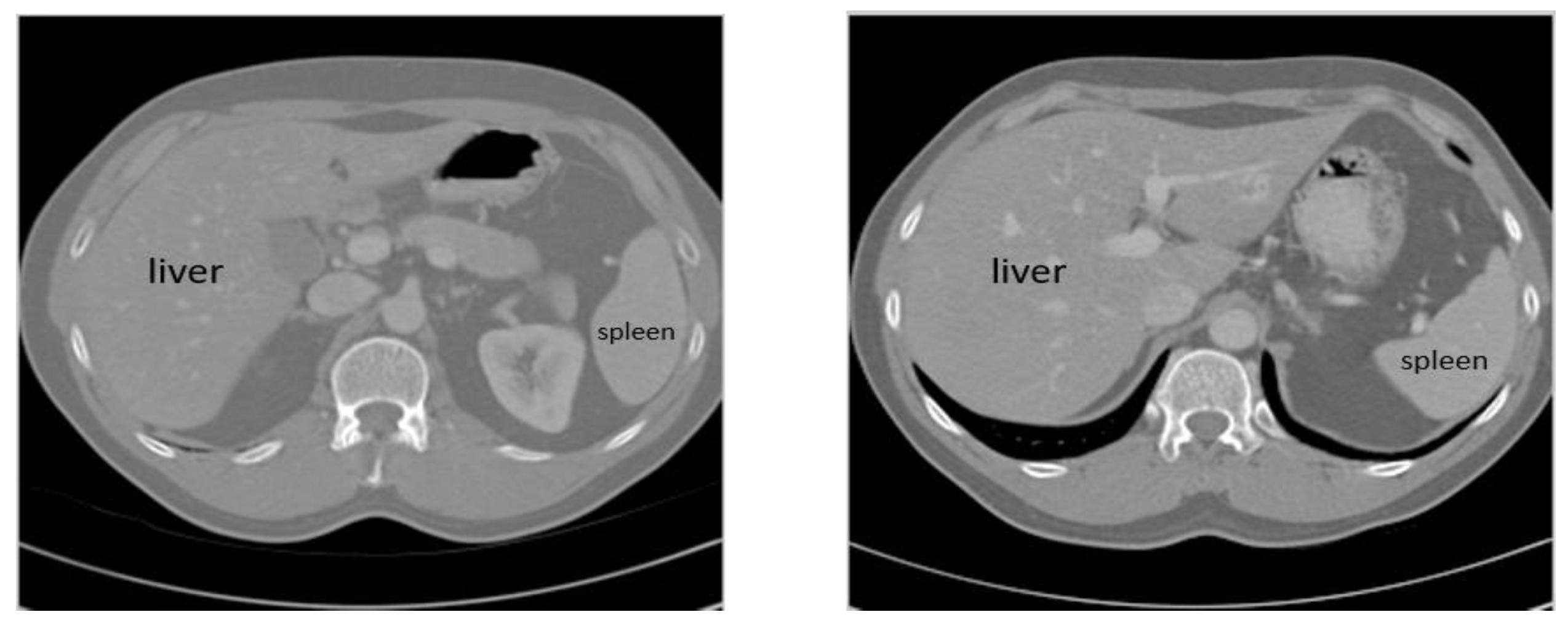 Sensors | Free Full-Text | Liver Tumor Segmentation in CT Scans ...